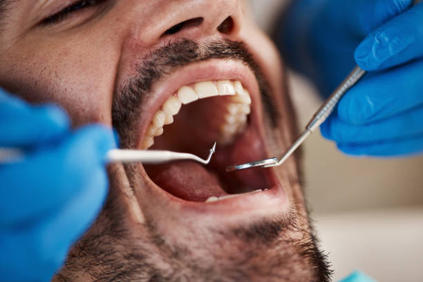 Best Emergency Dentist for Lost Fillings or Crowns in Jan Phyl Village, FL